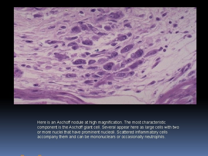 Here is an Aschoff nodule at high magnification. The most characteristic component is the Here is an Aschoff nodule at high magnification. The most characteristic component is the