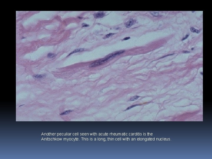 Another peculiar cell seen with acute rheumatic carditis is the Anitschkow myocyte. This is Another peculiar cell seen with acute rheumatic carditis is the Anitschkow myocyte. This is