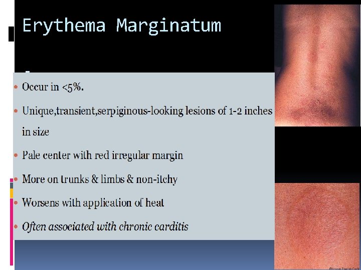 Erythema Marginatum . Erythema Marginatum .