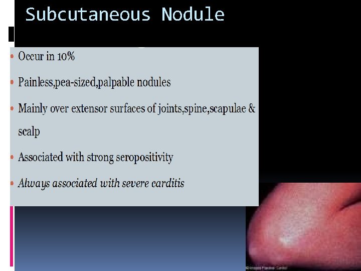 Subcutaneous Nodule Subcutaneous Nodule