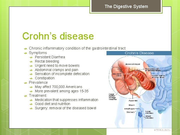 The Digestive System Crohn’s disease Chronic inflammatory condition of the gastrointestinal tract Symptoms Prevalence