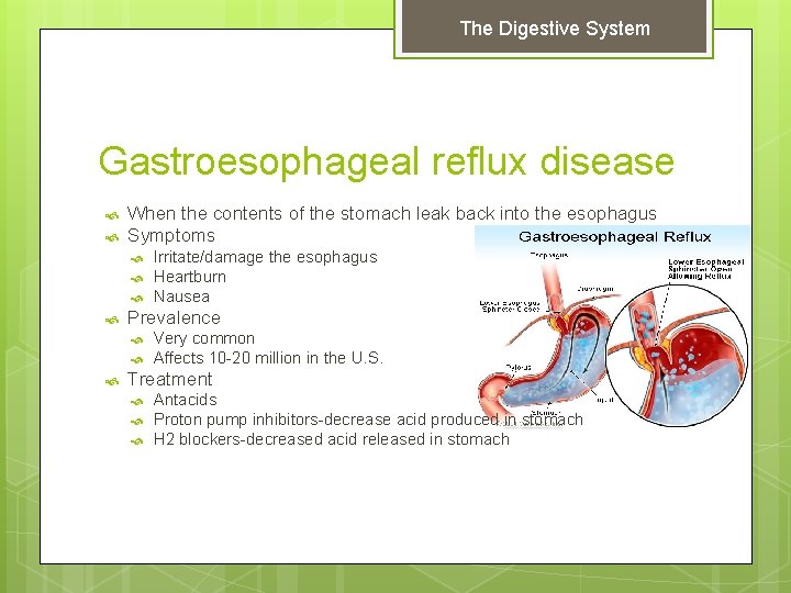 The Digestive System Gastroesophageal reflux disease When the contents of the stomach leak back