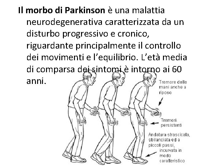 Il morbo di Parkinson è una malattia neurodegenerativa caratterizzata da un disturbo progressivo e