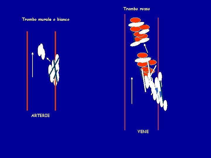 Trombo rosso Trombo murale o bianco ARTERIE VENE 