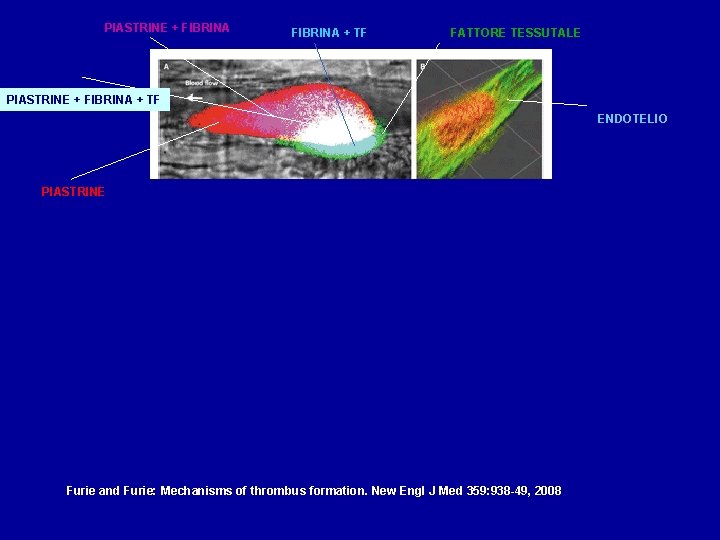 PIASTRINE + FIBRINA + TF FATTORE TESSUTALE PIASTRINE + FIBRINA + TF ENDOTELIO PIASTRINE