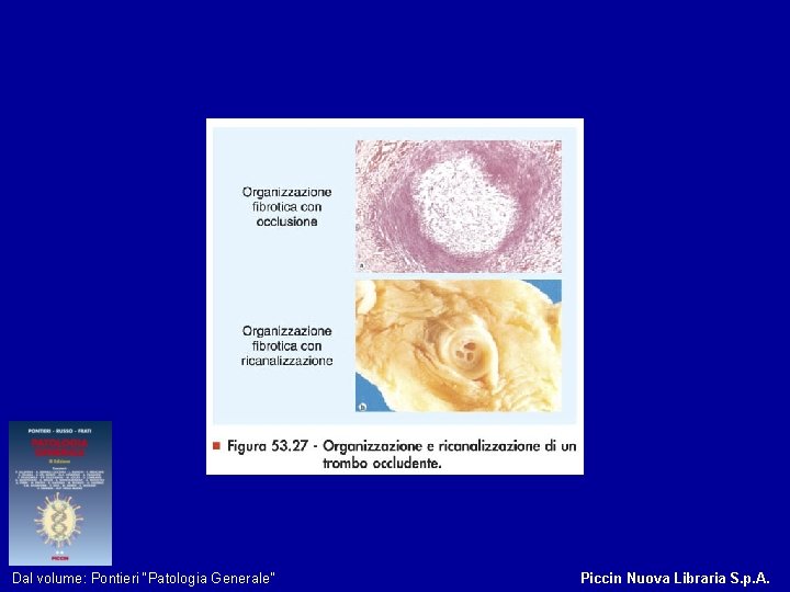 Figura 53. 27 - Organizzazione e ricanalizzazione di un trombo occludente. Dal volume: Pontieri