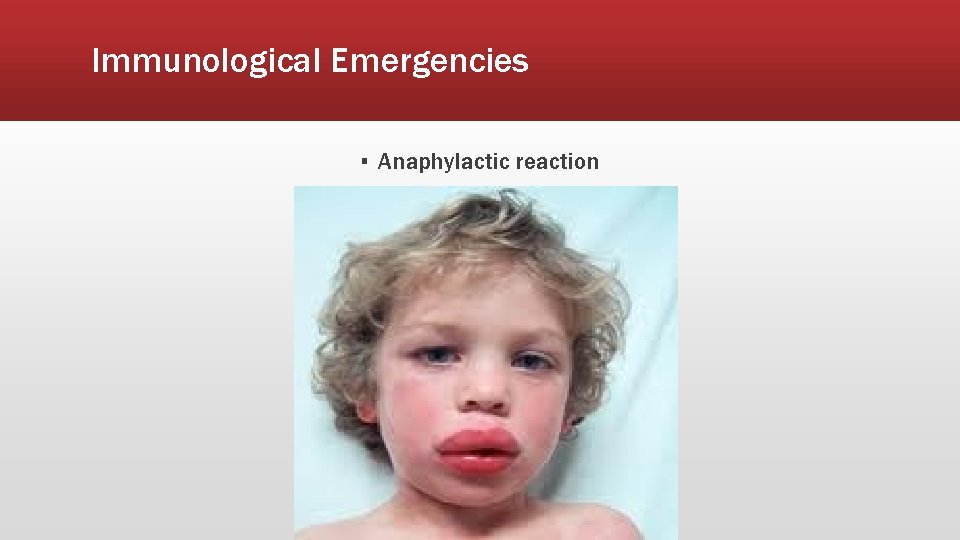 Immunological Emergencies ▪ Anaphylactic reaction 