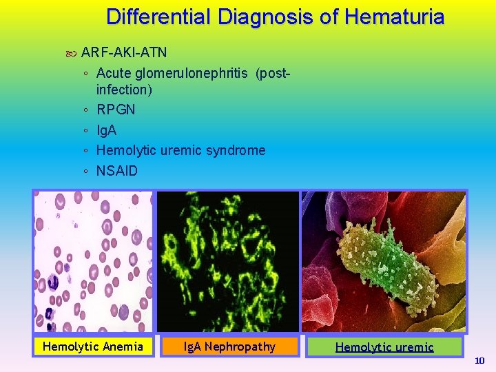Differential Diagnosis of Hematuria ARF-AKI-ATN ◦ Acute glomerulonephritis (postinfection) ◦ RPGN ◦ Ig. A