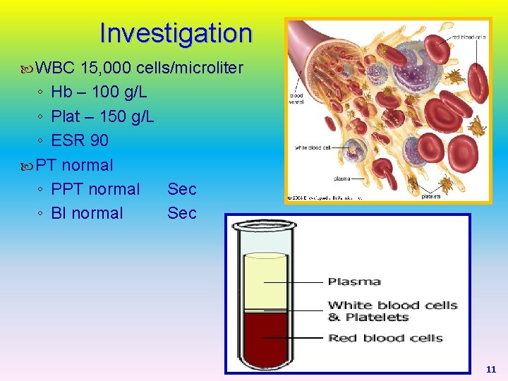 Investigation WBC 15, 000 cells/microliter ◦ Hb – 100 g/L ◦ Plat – 150