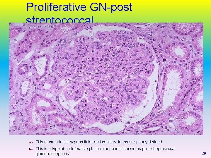 Proliferative GN-post streptococcal This glomerulus is hypercellular and capillary loops are poorly defined This