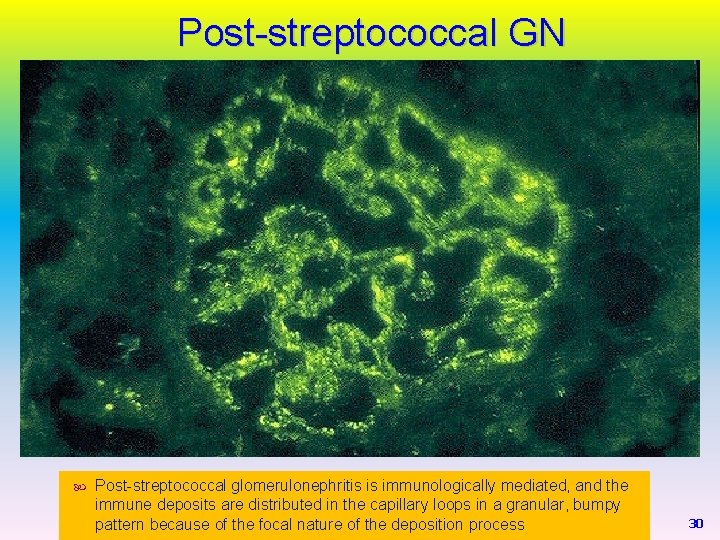 Post-streptococcal GN Post-streptococcal glomerulonephritis is immunologically mediated, and the immune deposits are distributed in