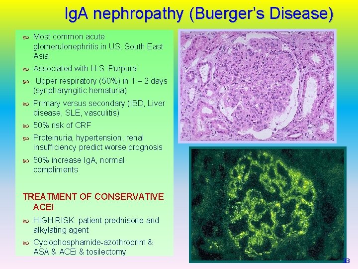 Ig. A nephropathy (Buerger’s Disease) Most common acute glomerulonephritis in US, South East Asia