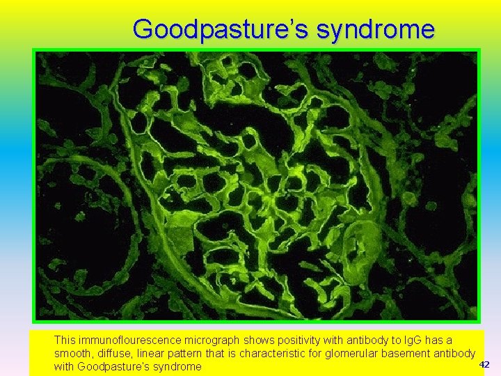 Goodpasture’s syndrome This immunoflourescence micrograph shows positivity with antibody to Ig. G has a