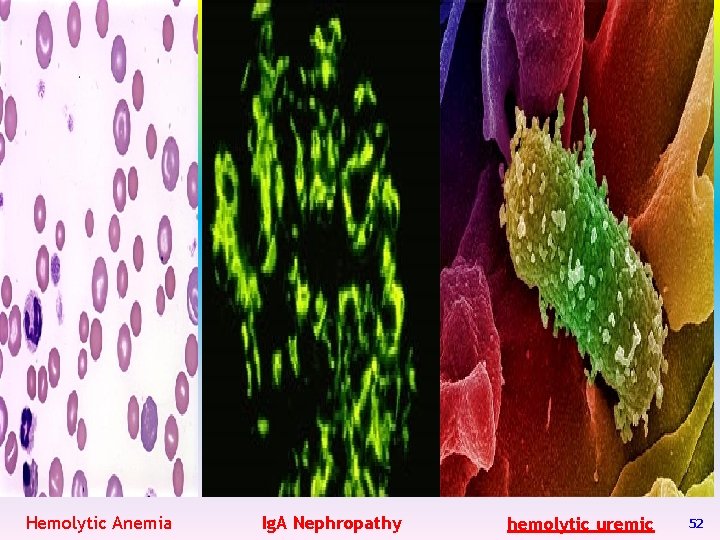 Hemolytic Anemia Ig. A Nephropathy hemolytic uremic 52 