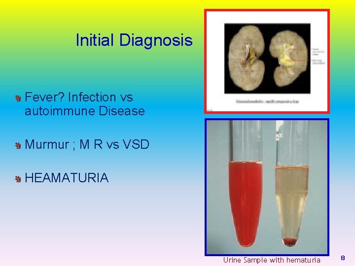 Initial Diagnosis Fever? Infection vs autoimmune Disease Murmur ; M R vs VSD HEAMATURIA