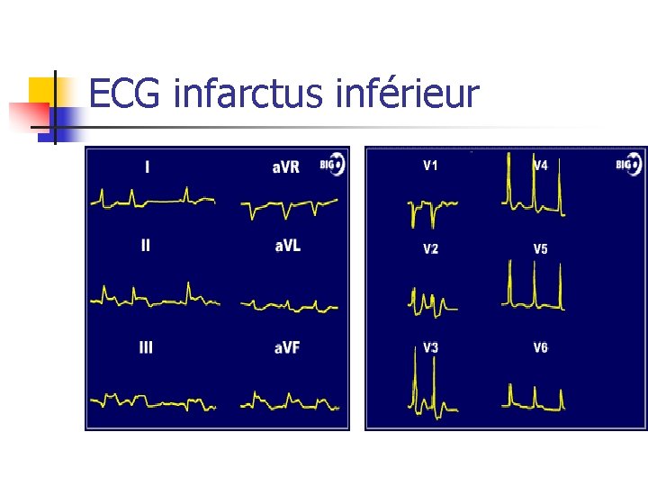 ECG infarctus inférieur 