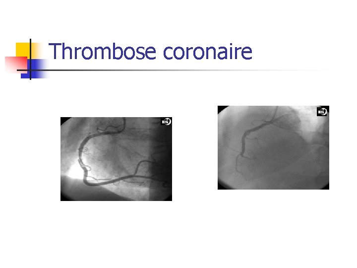 Thrombose coronaire 