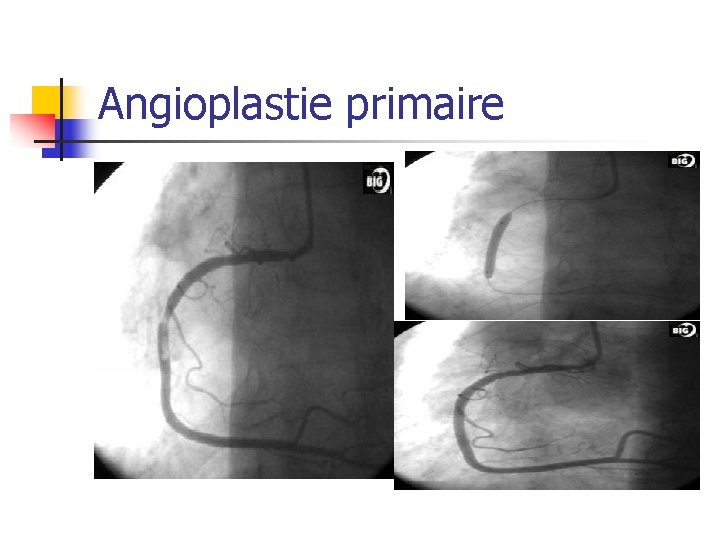 Angioplastie primaire 