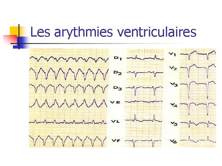 Les arythmies ventriculaires 