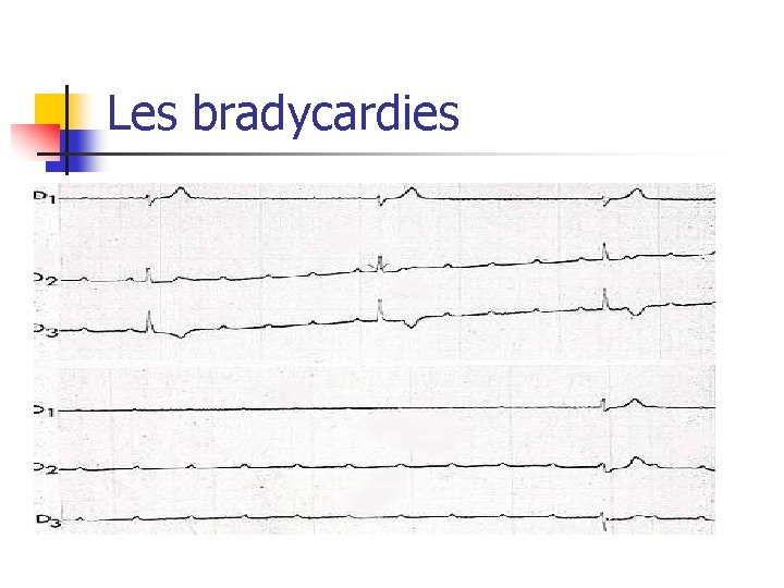 Les bradycardies 