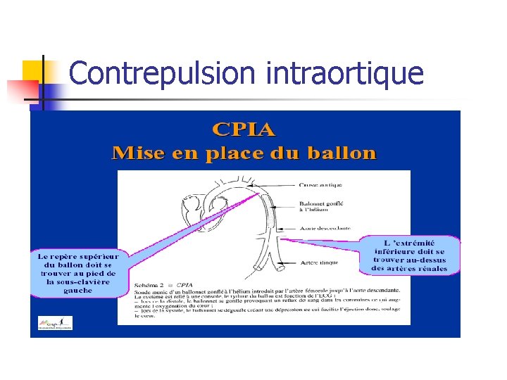 Contrepulsion intraortique 