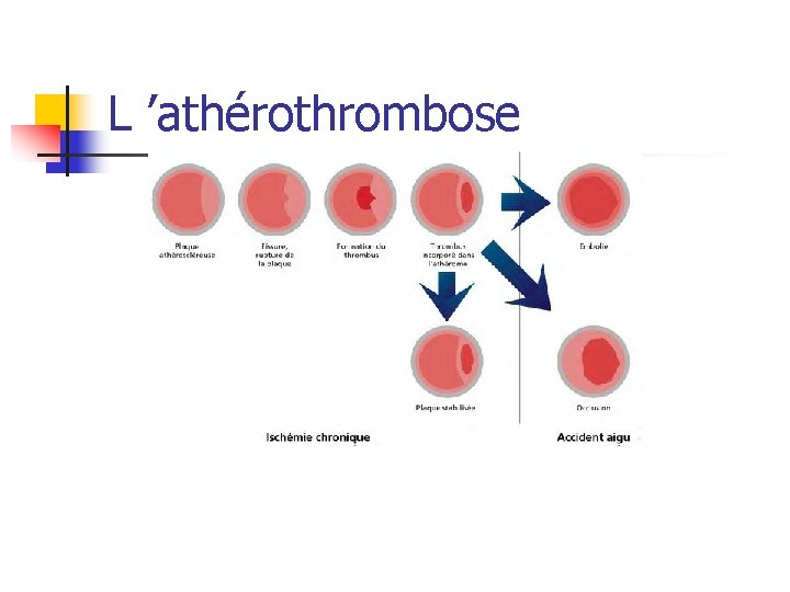 L ’athérothrombose 