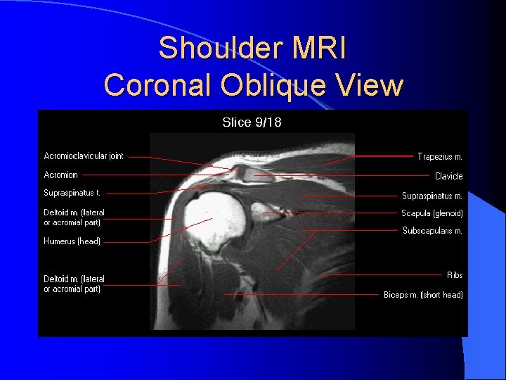 Shoulder MRI Coronal Oblique View Shoulder MRI Coronal Oblique View