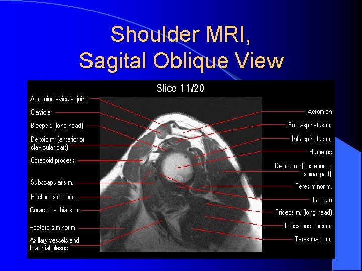 Shoulder MRI, Sagital Oblique View Shoulder MRI, Sagital Oblique View