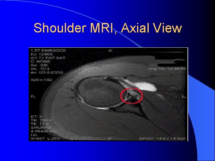 Shoulder MRI, Axial View Shoulder MRI, Axial View