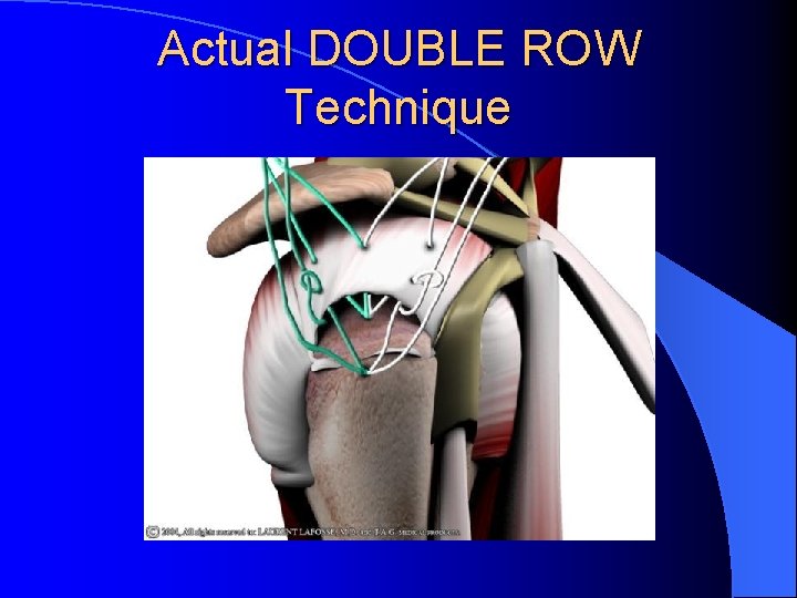Actual DOUBLE ROW Technique Actual DOUBLE ROW Technique