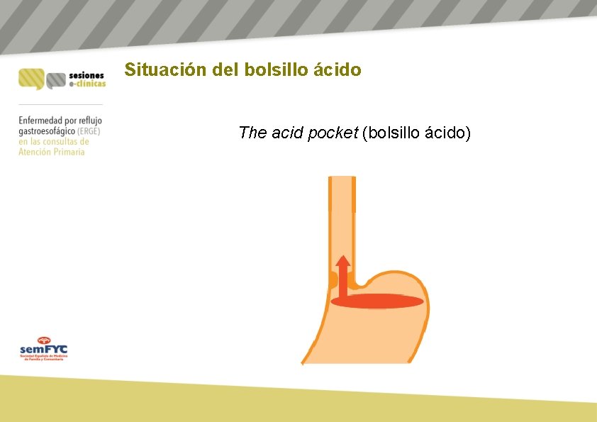 Situación del bolsillo ácido The acid pocket (bolsillo ácido) 