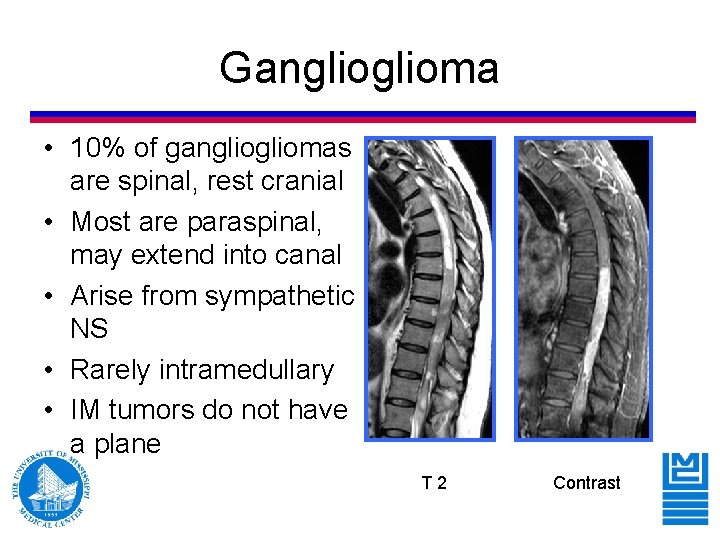Ganglioma • 10% of gangliomas are spinal, rest cranial • Most are paraspinal, may Ganglioma • 10% of gangliomas are spinal, rest cranial • Most are paraspinal, may