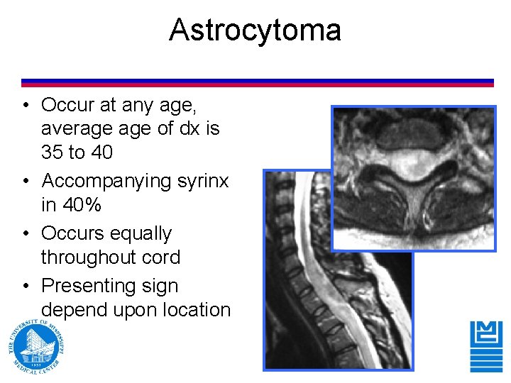 Astrocytoma • Occur at any age, average of dx is 35 to 40 • Astrocytoma • Occur at any age, average of dx is 35 to 40 •