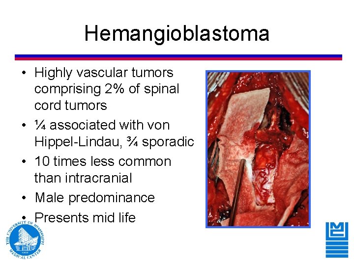 Hemangioblastoma • Highly vascular tumors comprising 2% of spinal cord tumors • ¼ associated Hemangioblastoma • Highly vascular tumors comprising 2% of spinal cord tumors • ¼ associated