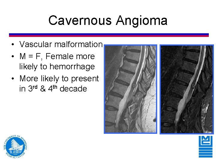 Cavernous Angioma • Vascular malformation • M = F, Female more likely to hemorrhage Cavernous Angioma • Vascular malformation • M = F, Female more likely to hemorrhage