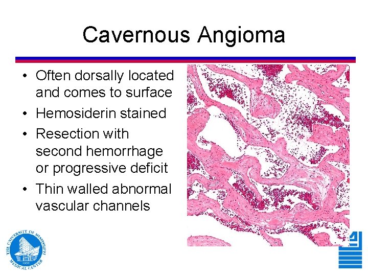 Cavernous Angioma • Often dorsally located and comes to surface • Hemosiderin stained • Cavernous Angioma • Often dorsally located and comes to surface • Hemosiderin stained •