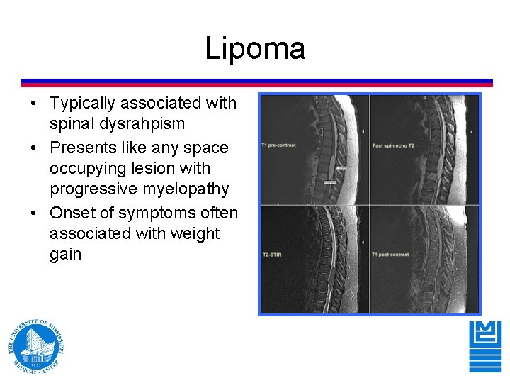 Lipoma • Typically associated with spinal dysrahpism • Presents like any space occupying lesion Lipoma • Typically associated with spinal dysrahpism • Presents like any space occupying lesion