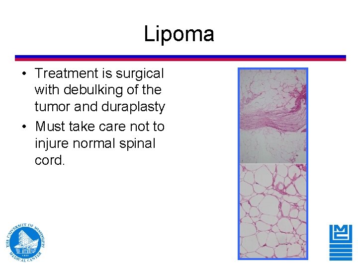 Lipoma • Treatment is surgical with debulking of the tumor and duraplasty • Must Lipoma • Treatment is surgical with debulking of the tumor and duraplasty • Must