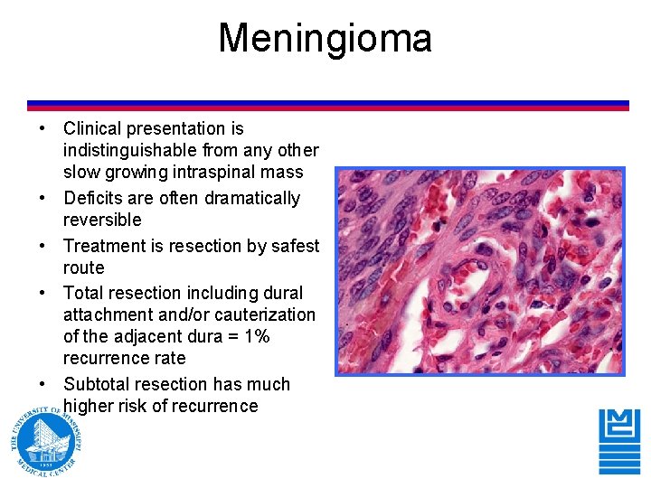 Meningioma • Clinical presentation is indistinguishable from any other slow growing intraspinal mass • Meningioma • Clinical presentation is indistinguishable from any other slow growing intraspinal mass •