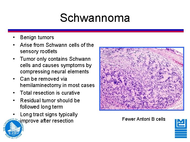 Schwannoma • Benign tumors • Arise from Schwann cells of the sensory rootlets • Schwannoma • Benign tumors • Arise from Schwann cells of the sensory rootlets •