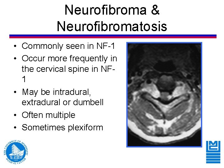 Neurofibroma & Neurofibromatosis • Commonly seen in NF-1 • Occur more frequently in the Neurofibroma & Neurofibromatosis • Commonly seen in NF-1 • Occur more frequently in the