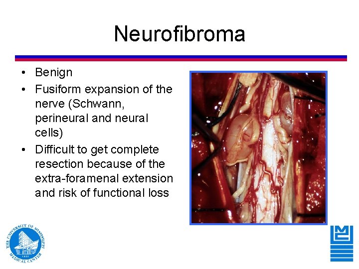 Neurofibroma • Benign • Fusiform expansion of the nerve (Schwann, perineural and neural cells) Neurofibroma • Benign • Fusiform expansion of the nerve (Schwann, perineural and neural cells)