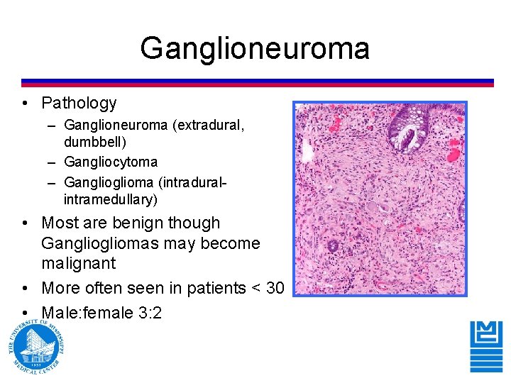 Ganglioneuroma • Pathology – Ganglioneuroma (extradural, dumbbell) – Gangliocytoma – Ganglioma (intraduralintramedullary) • Most Ganglioneuroma • Pathology – Ganglioneuroma (extradural, dumbbell) – Gangliocytoma – Ganglioma (intraduralintramedullary) • Most