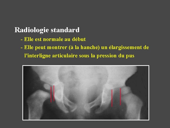 Radiologie standard - Elle est normale au début - Elle peut montrer (à la