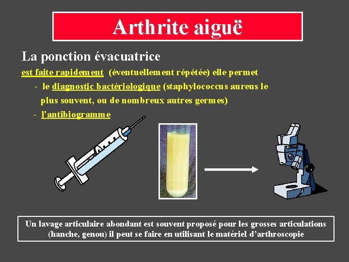 Arthrite aiguë La ponction évacuatrice est faite rapidement (éventuellement répétée) elle permet - le Arthrite aiguë La ponction évacuatrice est faite rapidement (éventuellement répétée) elle permet - le