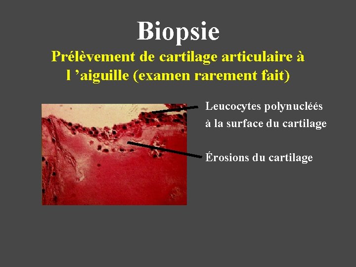 Biopsie Prélèvement de cartilage articulaire à l ’aiguille (examen rarement fait) Leucocytes polynucléés à Biopsie Prélèvement de cartilage articulaire à l ’aiguille (examen rarement fait) Leucocytes polynucléés à