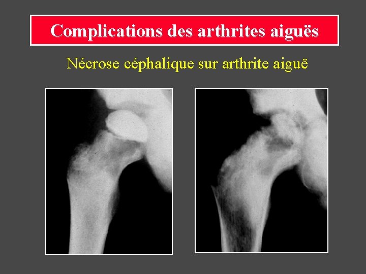 Complications des arthrites aiguës Nécrose céphalique sur arthrite aiguë 