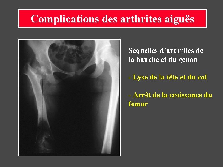 Complications des arthrites aiguës Séquelles d’arthrites de la hanche et du genou - Lyse Complications des arthrites aiguës Séquelles d’arthrites de la hanche et du genou - Lyse