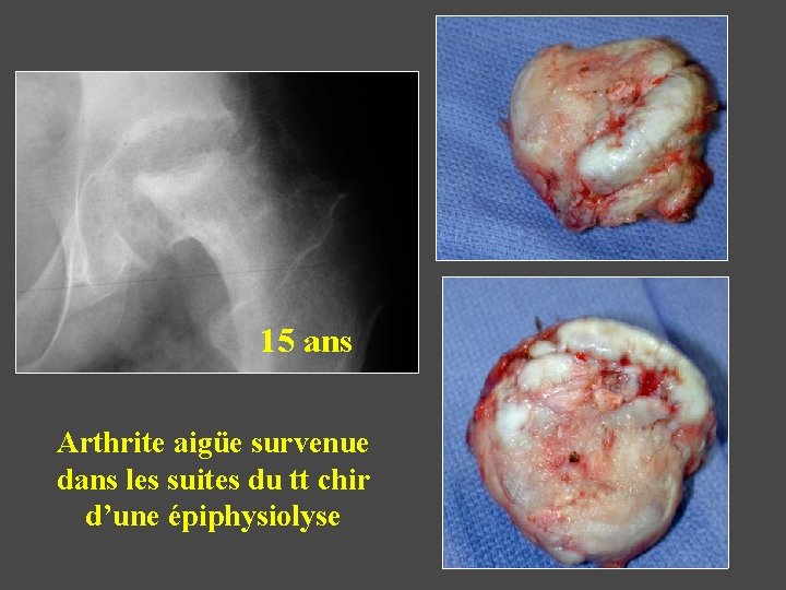 15 ans Arthrite aigüe survenue dans les suites du tt chir d’une épiphysiolyse 15 ans Arthrite aigüe survenue dans les suites du tt chir d’une épiphysiolyse