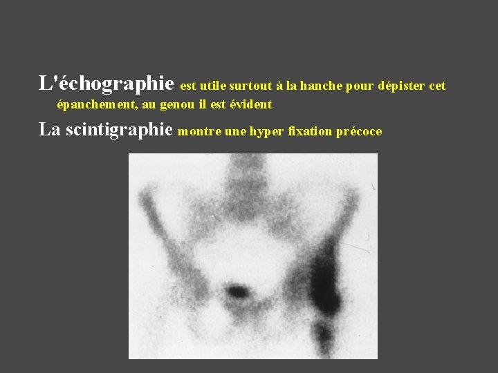 L'échographie est utile surtout à la hanche pour dépister cet épanchement, au genou il L'échographie est utile surtout à la hanche pour dépister cet épanchement, au genou il